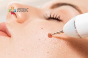 MesoTherapy Cosmetic UK Lesion Removal Service (3)