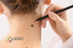 MesoTherapy Cosmetic UK Lesion Removal Service